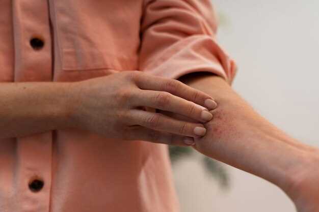 Managing Eczema with Escitalopram