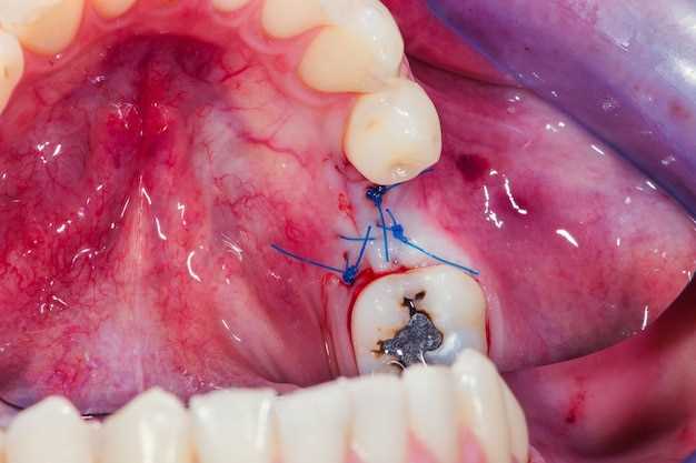 Escitalopram dental side effects