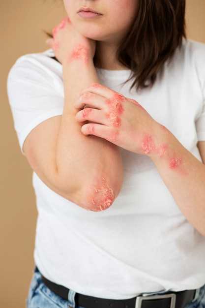 Escitalopram side effects rash